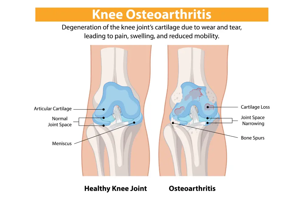 Knee Osteoarthritis