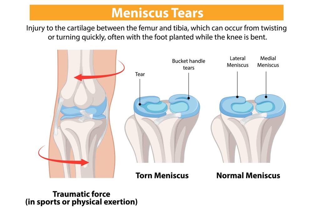 Meniscus Tear