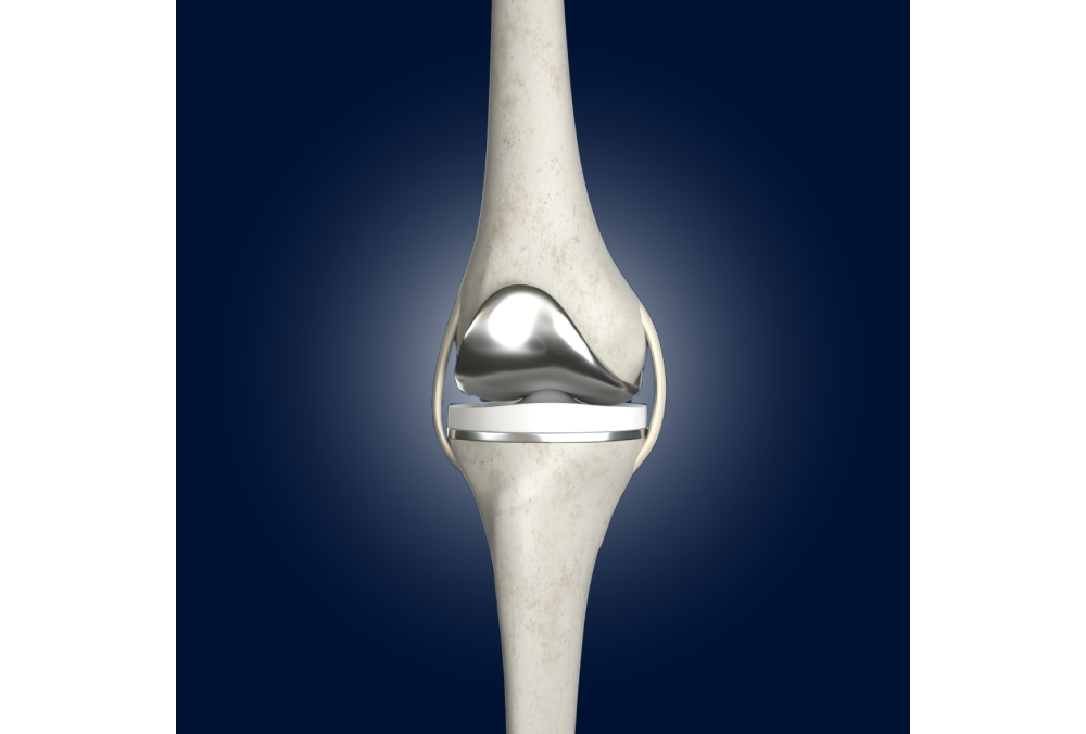 Robotic Knee Replacement